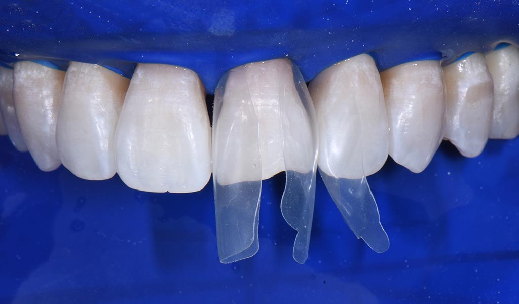 How Bioclear Empowers Dentists To Treat Black Triangles Optident